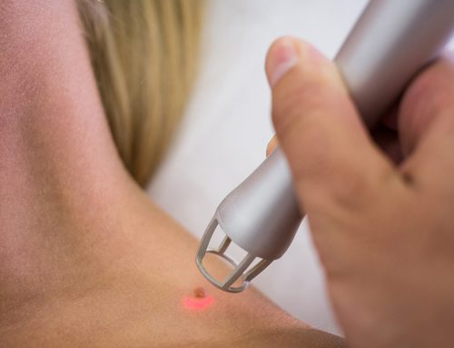 Odstránenie znamienka, výrastku, fibrómu frakčným CO2 laserom